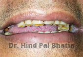 Dental Surgery in kalkaji