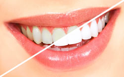Teeth Whitening in kalkaji